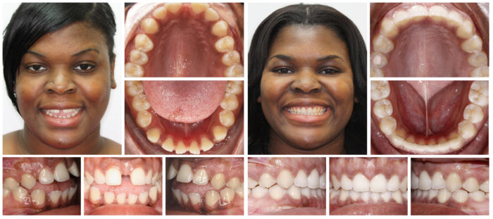Invisalign | The Art of Creating Smiles